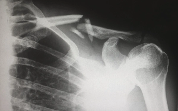 An x-ray showing a shoulder fracture requiring emergency medical treatment after a car crash