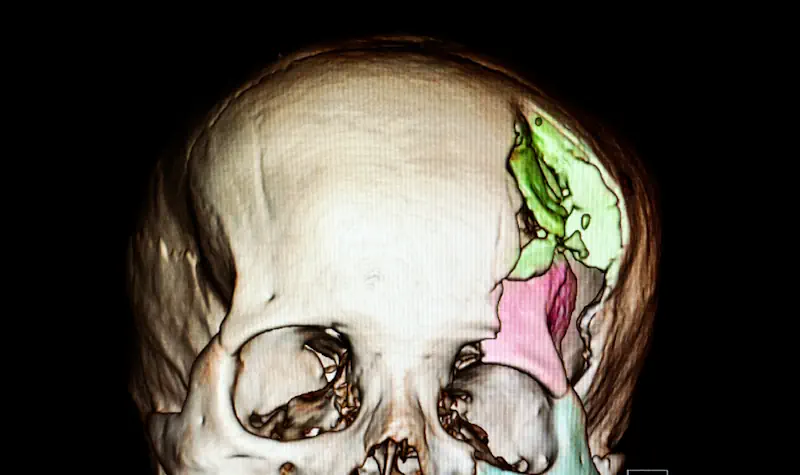An x-ray of a skull showing signs of grievous bodily harm