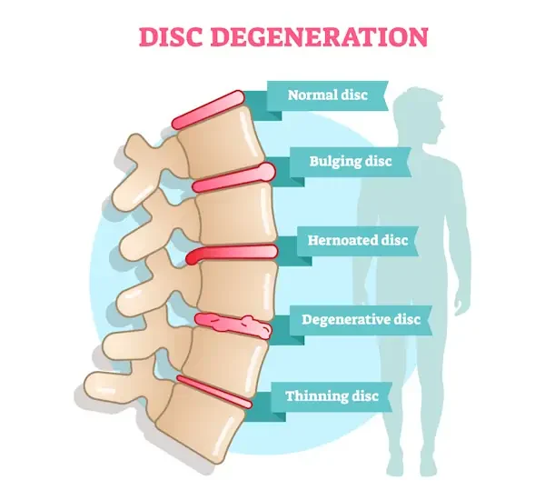 Disc degeneration infographic showing a bulging disc injury in the spine